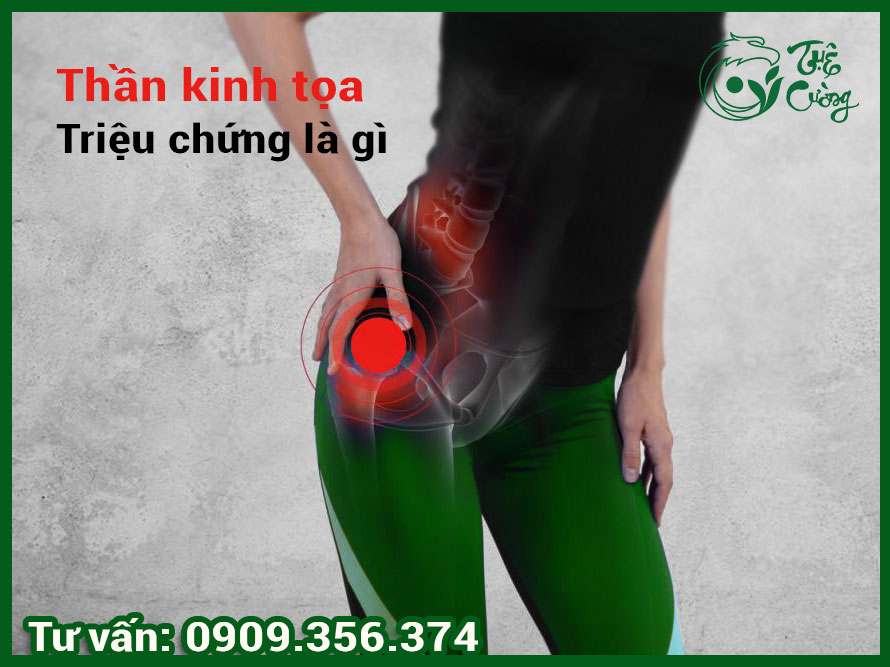 Hình minh họa đau dây thần kinh tọa