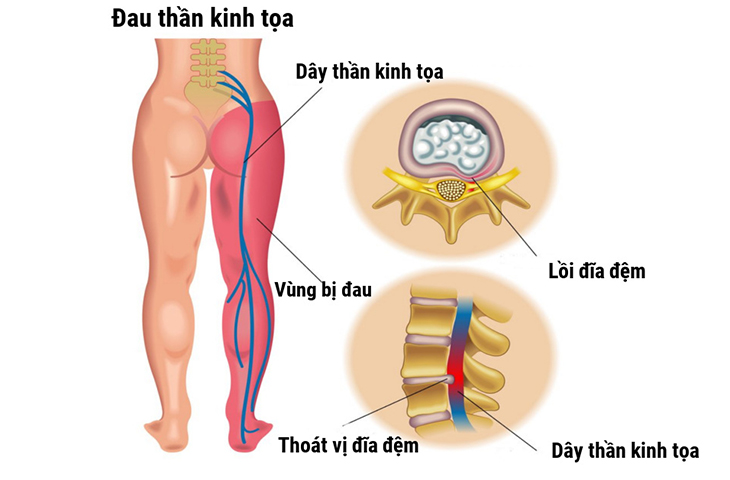 Hình minh họa đau dây thần kinh tọa