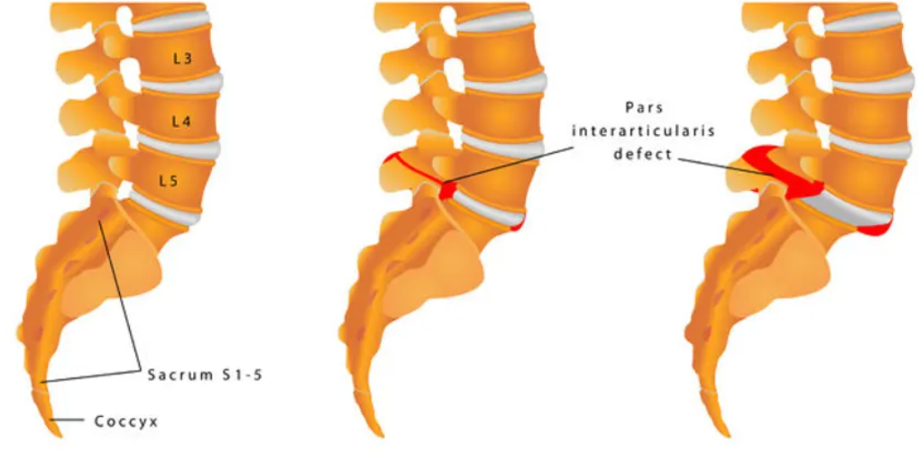 Hình minh họa trượt đốt sống