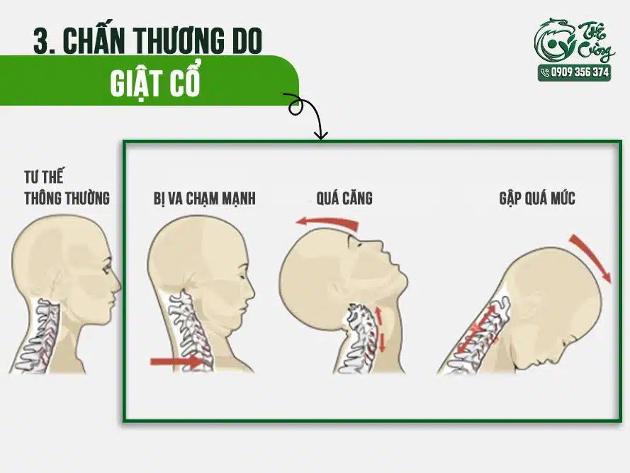Hình minh họa chấn thương do giật cổ
