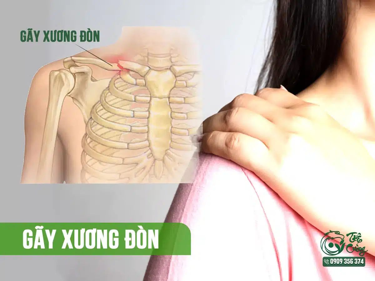 Hình minh họa đau cổ vai gáy do gãy xương đòn