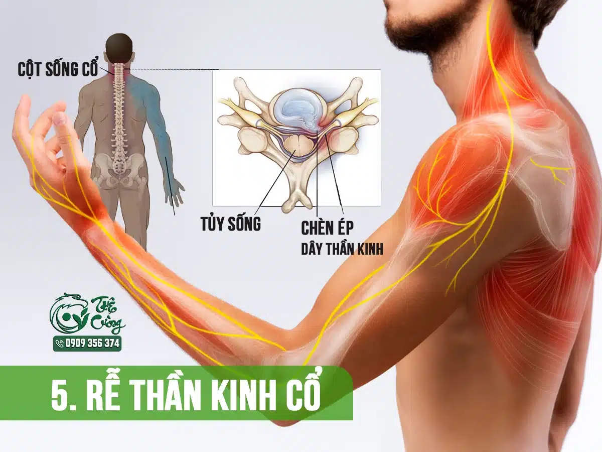 Hình minh họa rễ thần kinh cổ 
