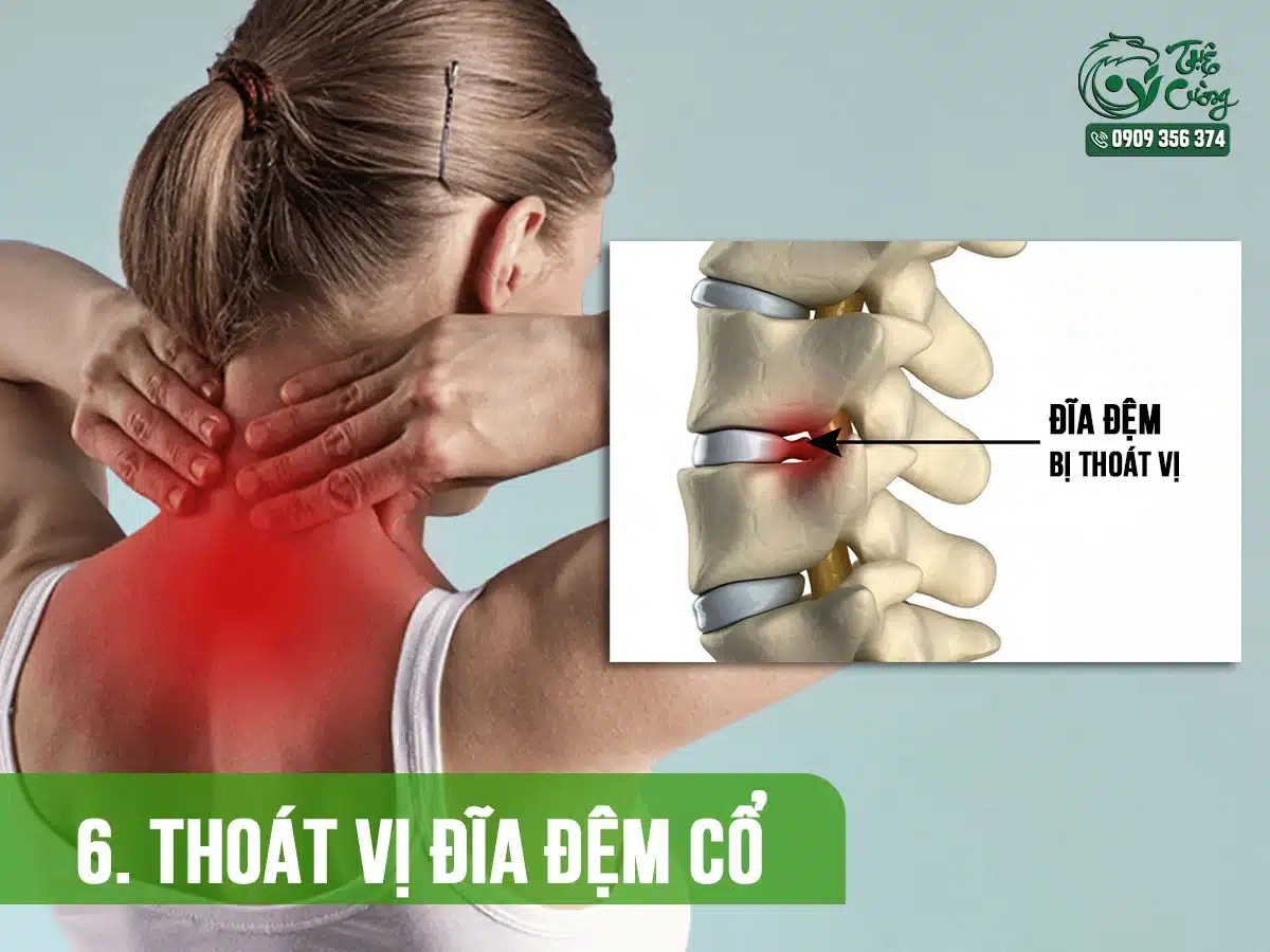 Hình minh họa thoát vị đĩa đệm cổ