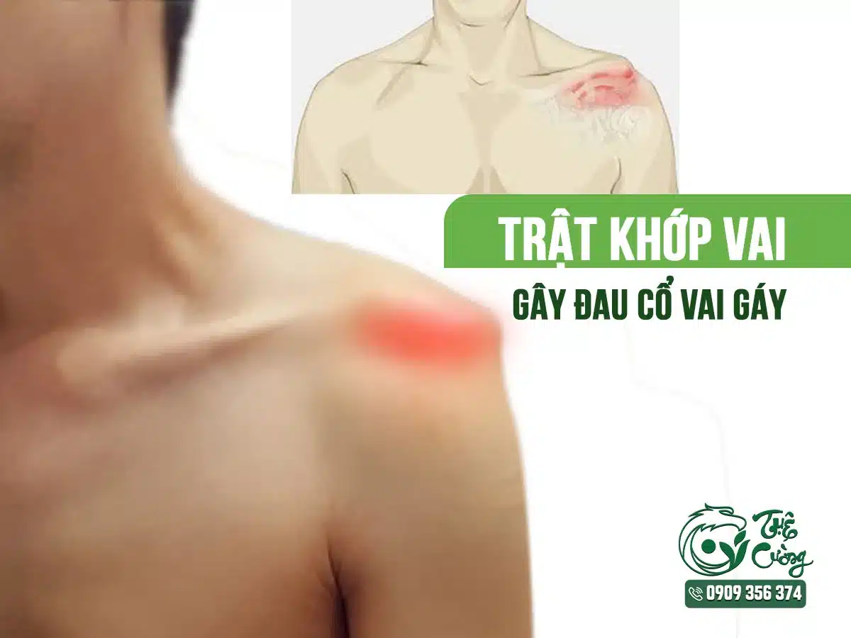 Hình minh họa đau cổ vai gáy do trật khớp vai