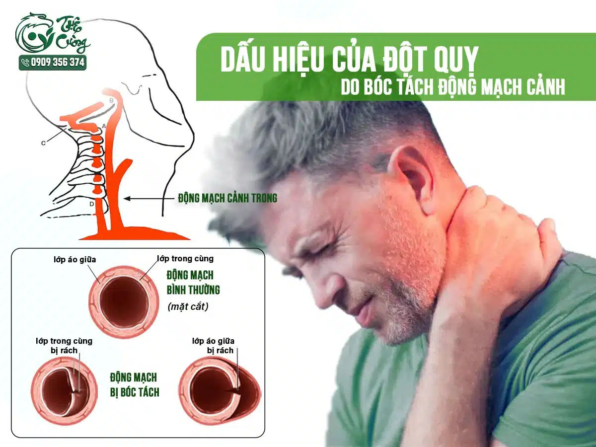 Hình minh họa đột quỵ do bóc tách động mạch cảnh