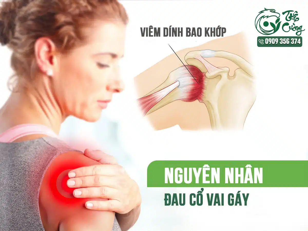 Hình minh họa đau cổ vai gáy do viêm dính bao khớp