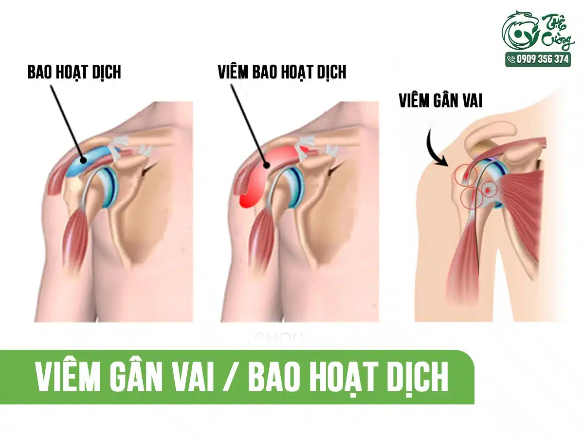 Hình minh họa đau cổ vai gáy do viêm gân vai viêm bao hoạt dịch