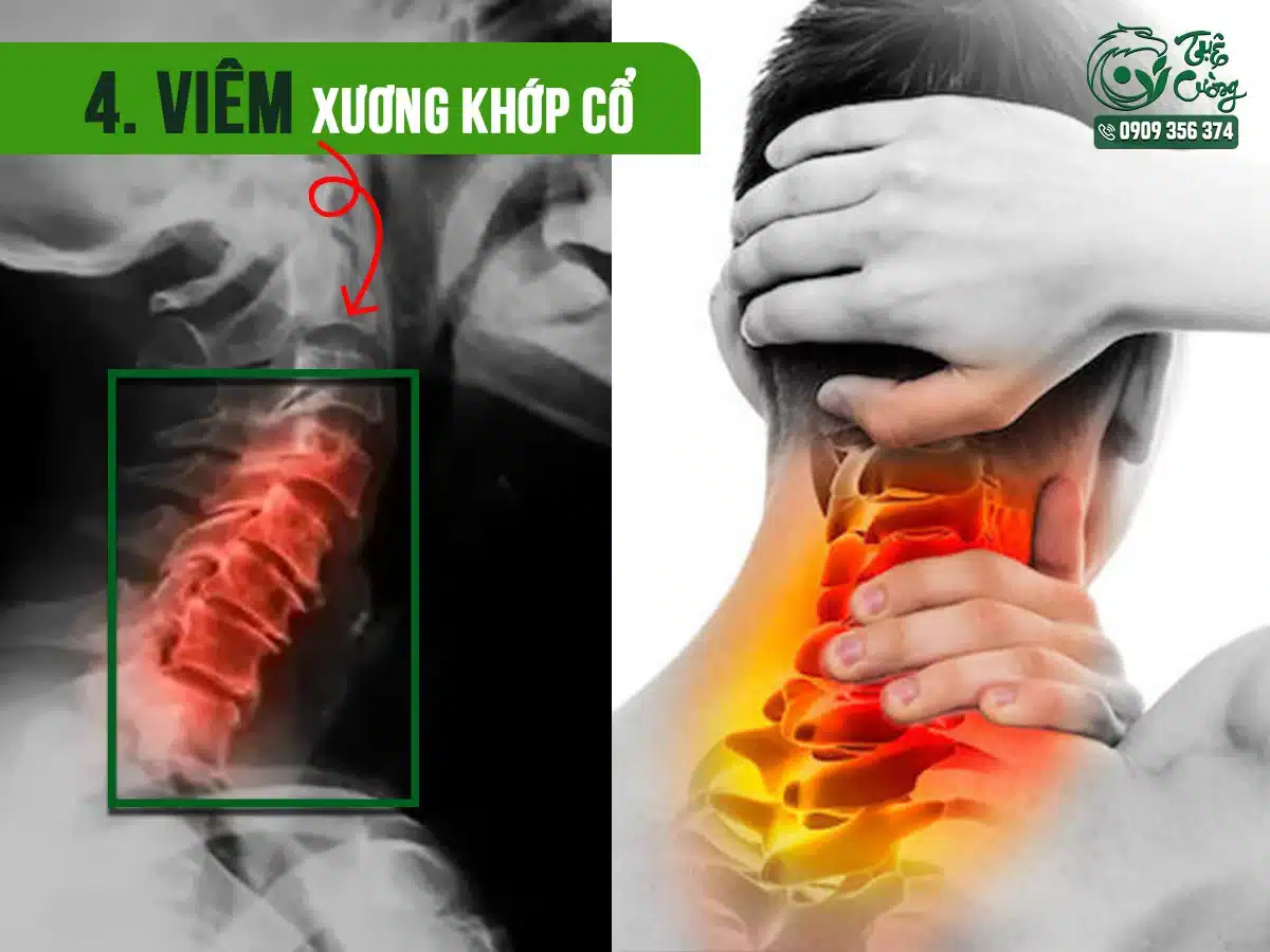 Hình minh họa viêm xương khớp cổ