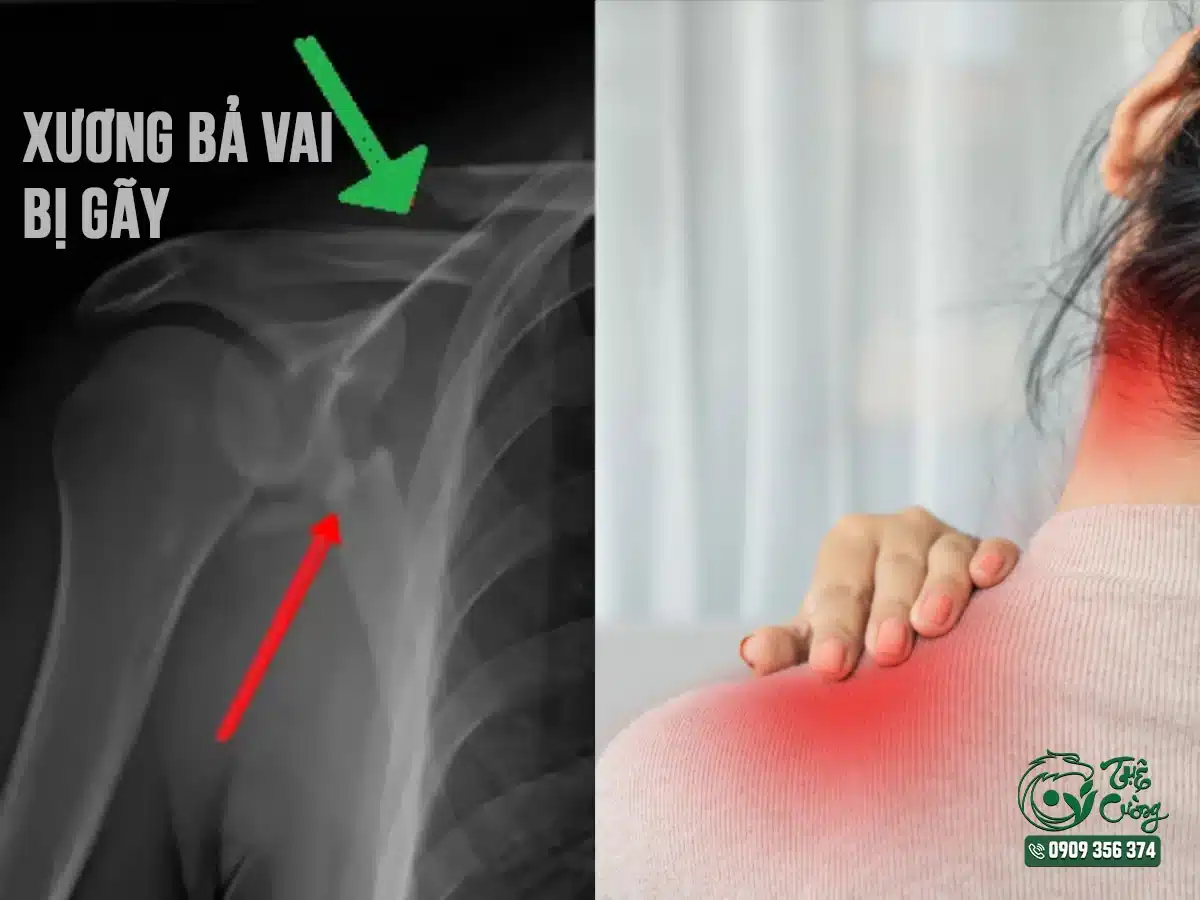 Hình minh họa đau cổ vai gáy do xương bả vai bị gãy